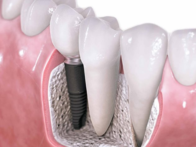 implante dental