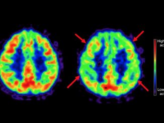 dieta alzheimer